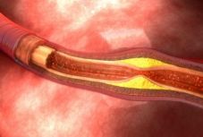 Számos tényező állhat az érelmeszesedés kialakulásának hátterében