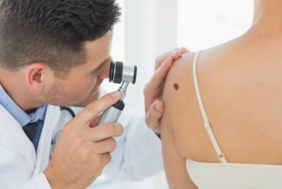 Odafigyeléssel csökkenthető a melanomás megbetegedés kockázata
