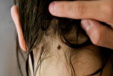 Parazitológus: a kullancsot minél hamarabb el kell távolítani