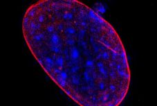 Kiderült, mitől lehet agresszívabb a prosztatarák