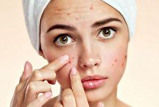 Pattanások elleni harc: minden az étrenddel kezdődik