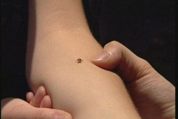 Kullancscsípés okozott részleges paralízist egy 14 éves aradi fiúnál
