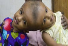 Bangladesben lesz a fejüknél összenőtt sziámi ikrek végleges szétválasztó műtétje