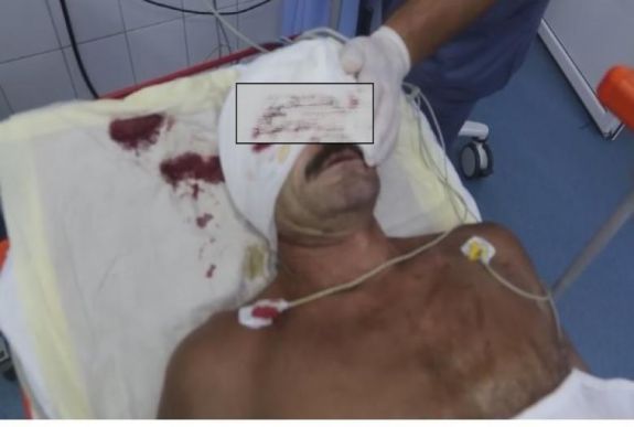 Megharapta egy férfi arcát egy medve Hargita megyében