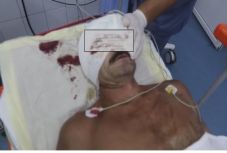 Megharapta egy férfi arcát egy medve Hargita megyében