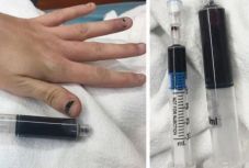 Túl sok fájdalomcsillapítót vett be egy nő: bekékült a vére