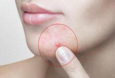 Felnőttkori pattanások? Ez is lehet az oka