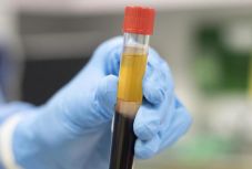 A vérplazmakezelés is hatásos lehet koronavírus ellen