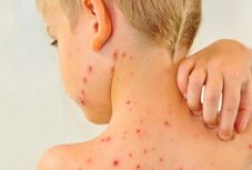 Újabb 48 kanyarós esetet jelentettek Romániában