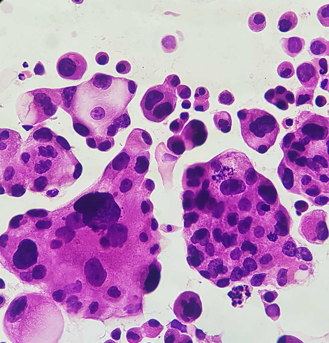 Rosszindulatú daganatos sejtek egy citológiai kenetben.