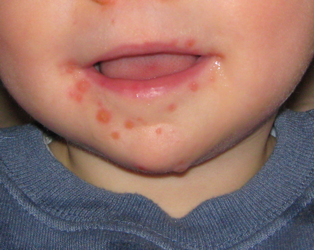Vörös foltok és kiütések kéz-láb-száj betegségben szenvedő gyerek szája körül | Fotó forrása: Wikipédia