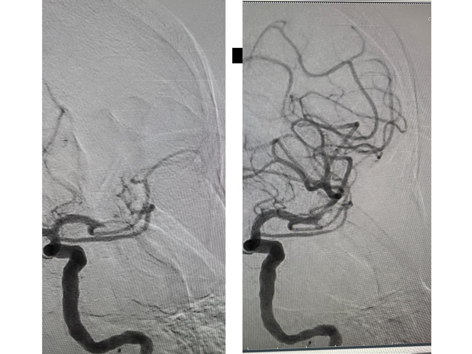 Felvétel a vérrögről az eltávolítás előtt | Fotó: Csíkszeredai Megyei Sürgősségi Kórház