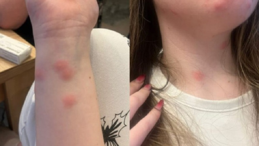 Összecsípték a vonaton a poloskák | Fotó: képernyőmentés