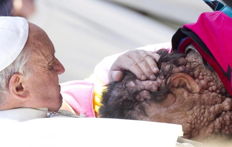 2013. november 6. - Vatikán: általános audiencia a Szent Péter téren, ahol Ferenc pápa egy rendkívül ritka bőrbetegségtől szenvedő férfit áldott meg, és imádkozott érte. A férfi egy genetikai rendellenességtől, a neurofibromatózistól szenved, melytől a be